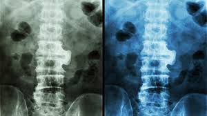 What Should You Not Do With Ankylosing Spondylitis?