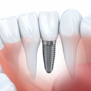 Dental Implants in Beaconsfield and Expert Dental Care in Mernda: Your Guide to Healthy Smiles