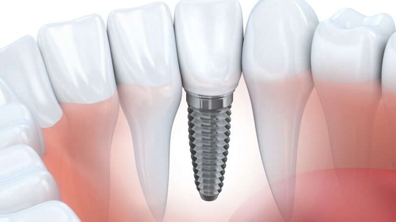 Dental Implants in Beaconsfield and Expert Dental Care in Mernda: Your Guide to Healthy Smiles