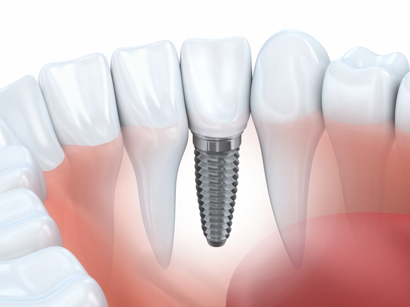 Dental Implants in Beaconsfield and Expert Dental Care in Mernda: Your Guide to Healthy Smiles